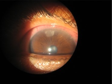 Corneal Abscess